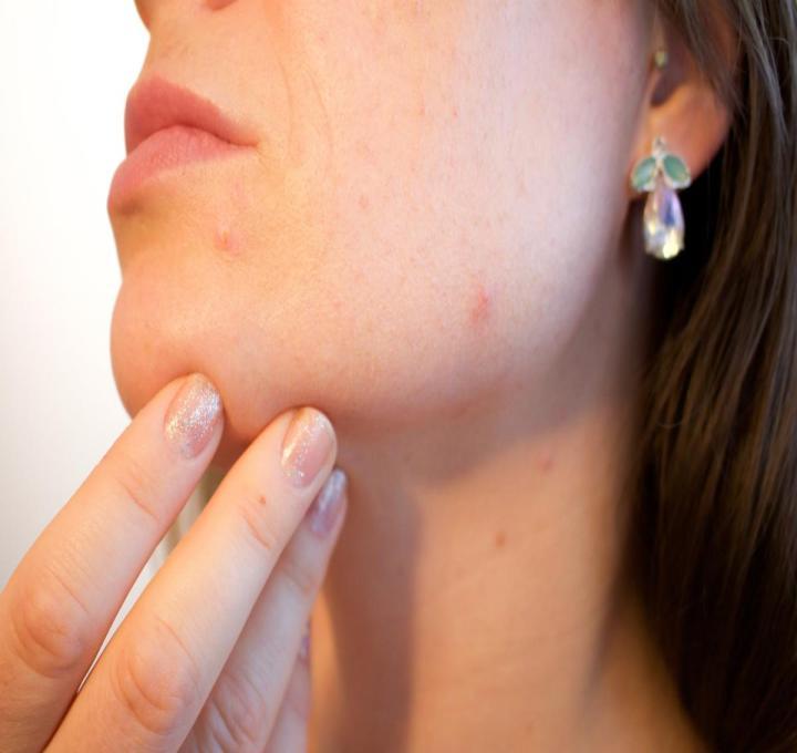 acne-g08f44aad5_1920_0_0.jpg
